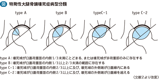 大腿骨頭壊死症 – 日本医事新報社