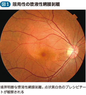 中心性漿液性脈絡網膜症 – 日本医事新報社