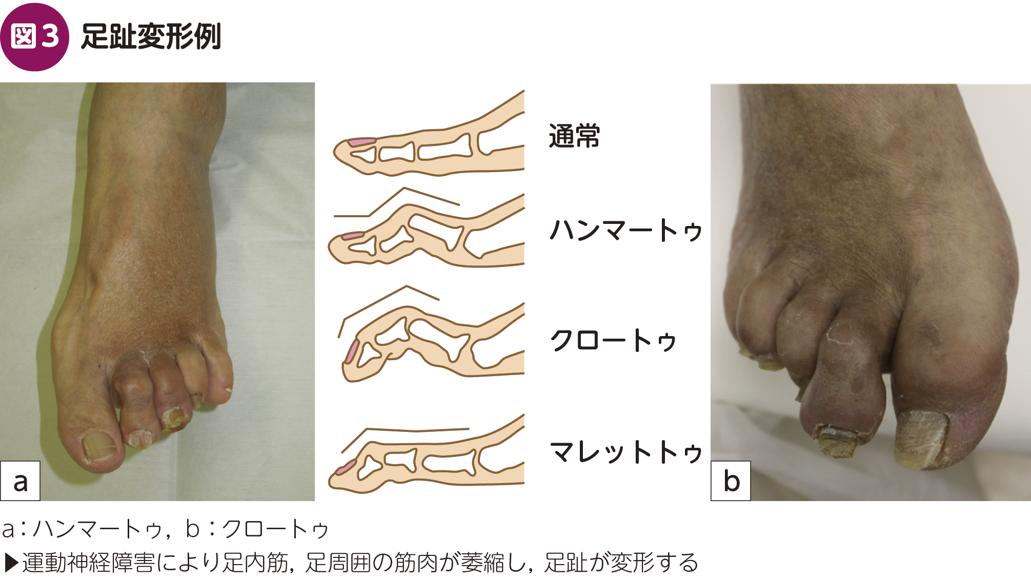 FOCUS：内科で見逃さない！ 糖尿病足病変〈かかりつけ医が気づくべき
