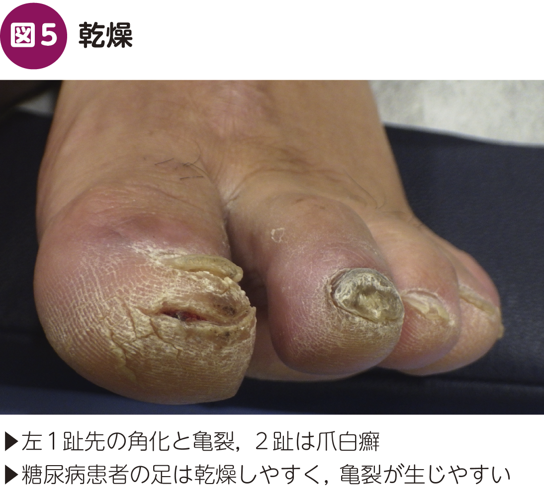 FOCUS：内科で見逃さない！ 糖尿病足病変〈かかりつけ医が気づくべき