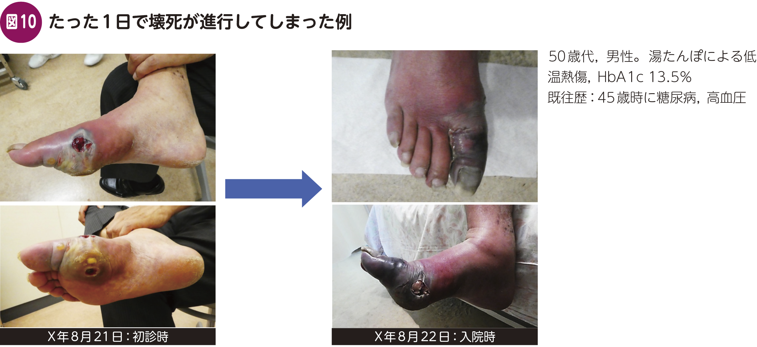 FOCUS：内科で見逃さない！ 糖尿病足病変〈かかりつけ医が気づくべき