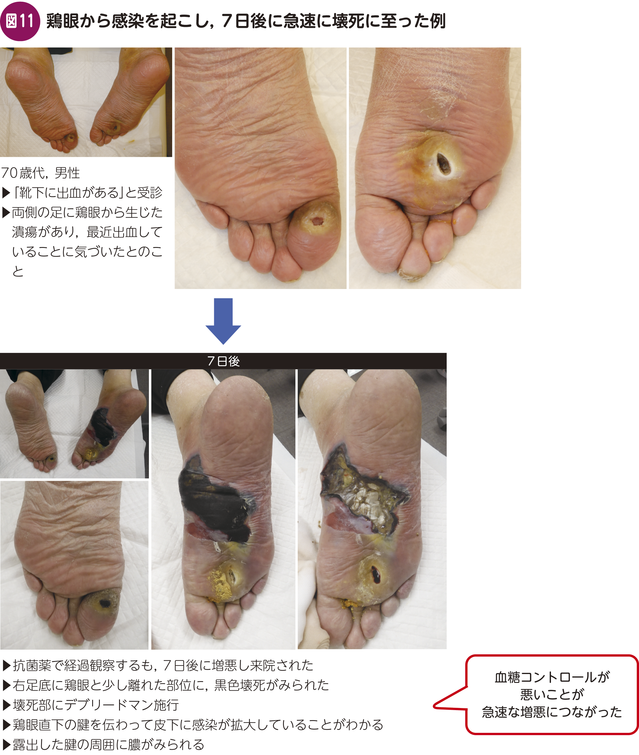 FOCUS：内科で見逃さない！ 糖尿病足病変〈かかりつけ医が気づくべき