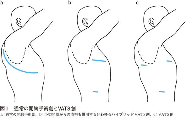 2）胸腔鏡下肺切除術 ［特集：期待される肺癌の低侵襲手術］ – 日本