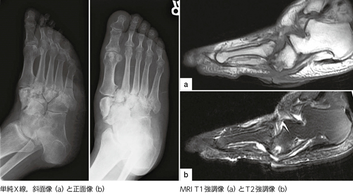 糖尿病性足潰瘍（骨髄炎）？→下腿切断？［画像診断道場〜実はこうだっ