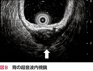 胃粘膜下腫瘍……それとも？［画像診断道場～実はこうだった（158