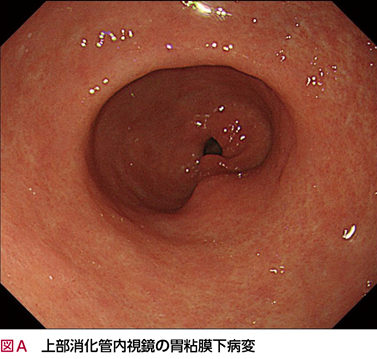 LIKIYA クッション サイン 3 胃粘膜下腫瘍……それとも？［画像診断道場～実はこうだった（158