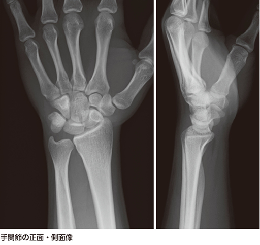 受傷機転から有鉤骨鉤骨折と診断……？［画像診断道場～実はこうだった