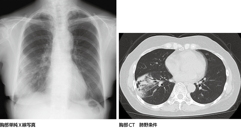 画像所見は感染性肺炎を疑わせるが……？［画像診断道場～実はこうだった
