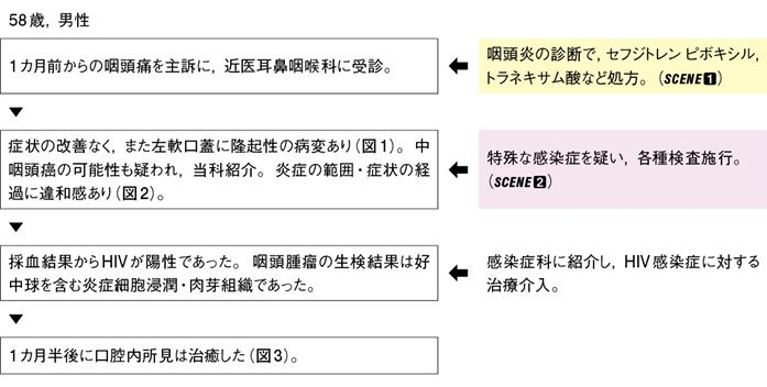 非典型的な咽頭炎を契機に診断されたHIV感染症［難渋症例から学ぶ