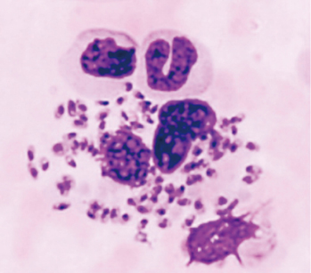 ガンは治って当たり前! 癌は寄生虫が原因だった!? 超稀少疾患としての寄生虫病（所 正治）［プラタナス］ – 日本医事新報社