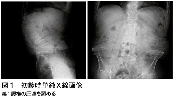 骨粗鬆性椎体骨折による腰椎偽関節に対する椎体置換［難渋症例から学ぶ