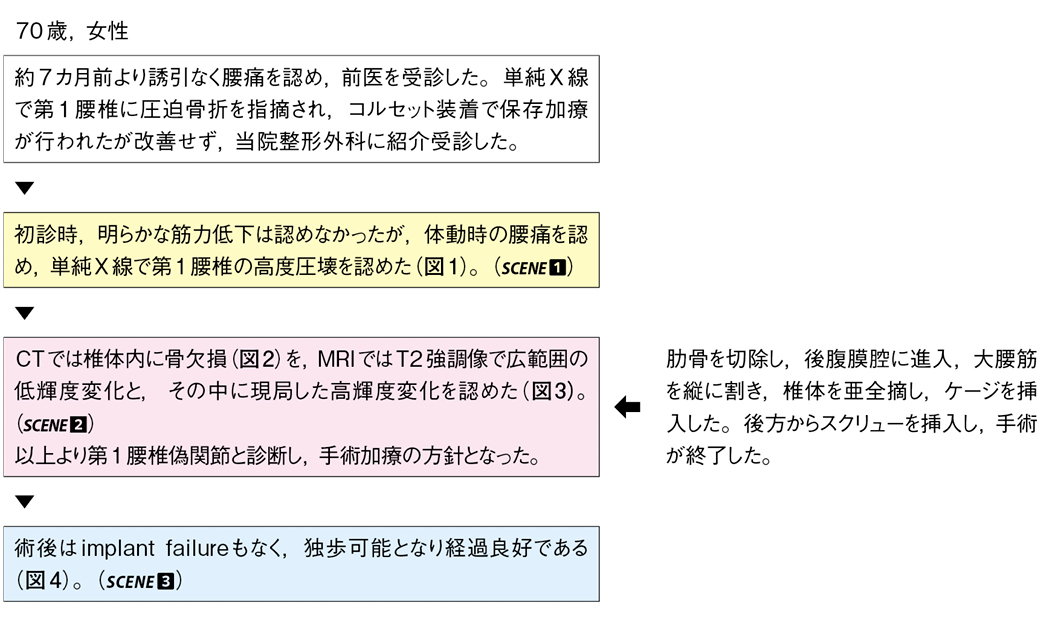 骨粗鬆性椎体骨折による腰椎偽関節に対する椎体置換［難渋症例から学ぶ