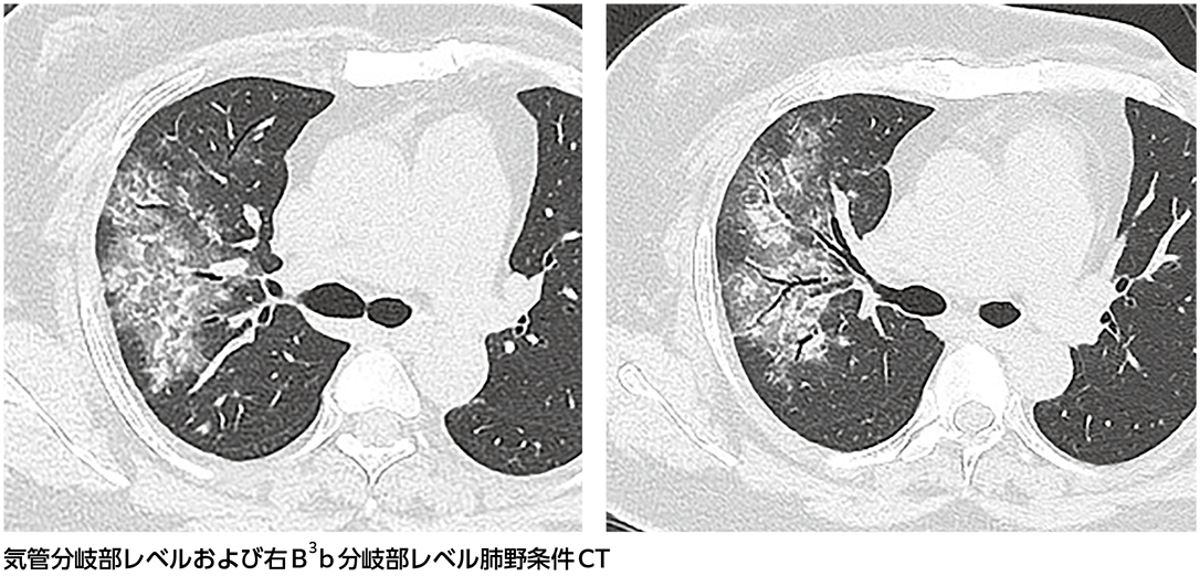 抗菌薬に反応しない……，肺胞性肺炎？ ……ズバリ診断は？［画像診断道場