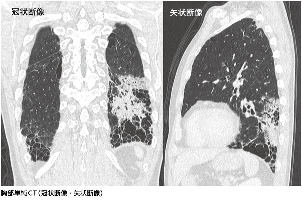 胸部のCT 胸部単純CTでの左下葉の浸潤影増大……診断は？［画像診断道場～実はこう