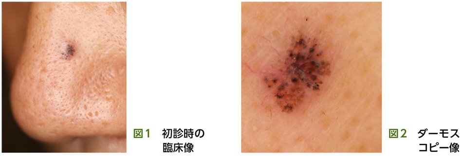 皮膚癌の新常識：他疾患との鑑別［〈プライマリ・ケア医が知っておく